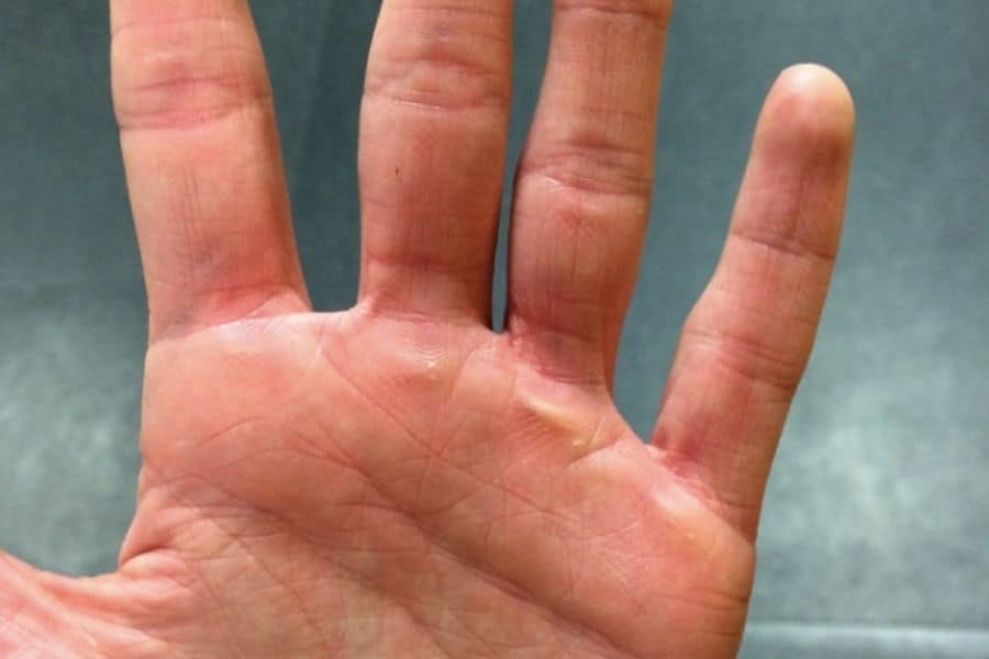 Hand callouses using dumbbells without gloves.