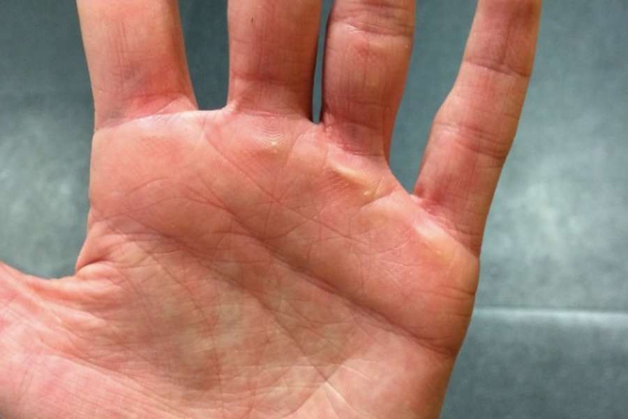Metal dumbbell handles can cause a beginner's hand to develop calluses.